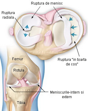 deteriorarea și ruperea meniscului articulației genunchiului