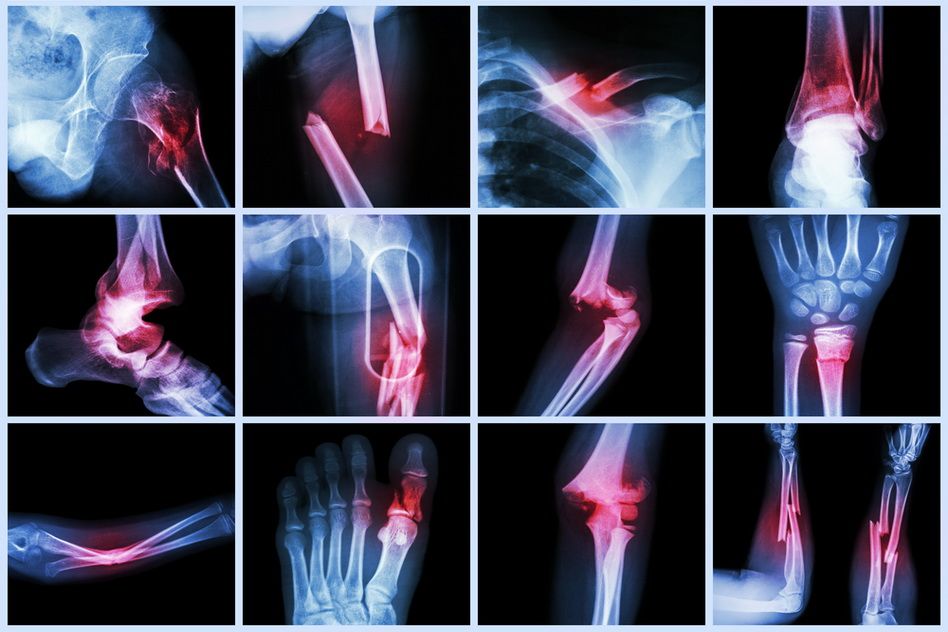 tratamentul articulației brațului fracturilor