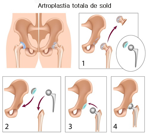 Recuperarea postprotezare de şold | Artroplastia | Protezare sold - Protezare genunchi