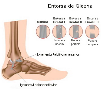 Umflarea articulației gleznei după alergare, Simptome ale entorsei