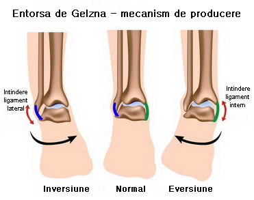 osteoartrita deformantă a articulației genunchiului de gradul II artrita articulațiilor mici ale piciorului